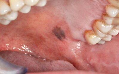 Pigmentaciones de la mucosa oral (Eflorescencias)