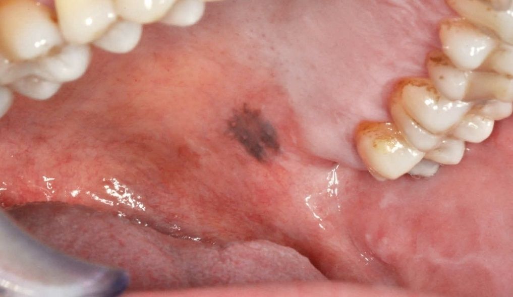 Pigmentaiones de la mucosa oral (Eflorescencias) Melanoma dr Abad Jaén