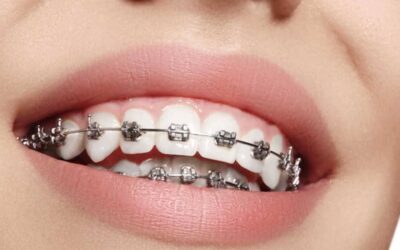 ¿Cuándo debería ponerme ortodoncia de brackets?