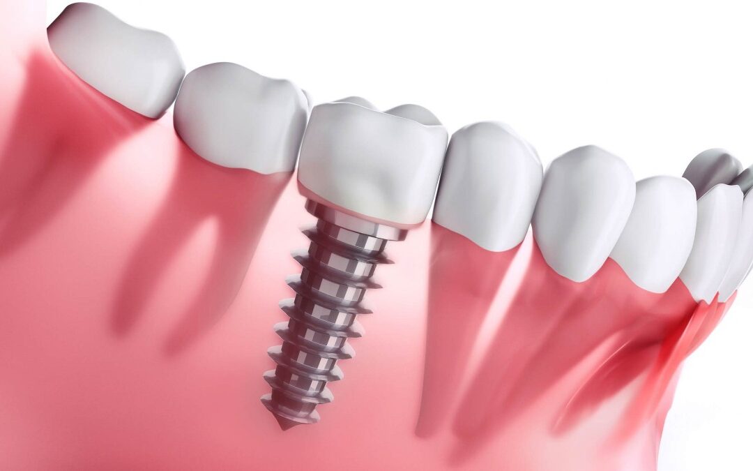 ¿Por qué debería ponerme implantes dentales?