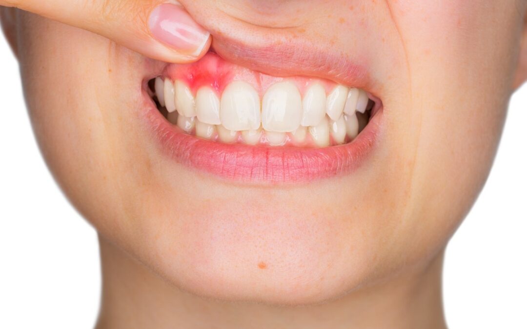 Cómo prevenir la periodontitis