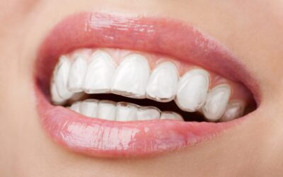 ¿Necesitas ortodoncia? Te contamos todas las ventajas de la ortodoncia invisible Invisalign