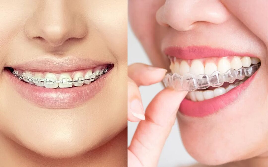 Ortodoncia: ¿Cuál es la mejor opción para ti, convencional o invisible?
