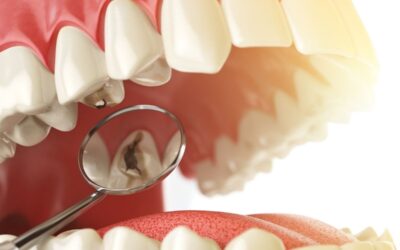 Caries: Tratamientos actuales y prevención