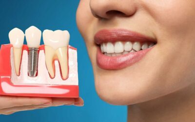 Implantes dentales: recupera la funcionalidad de tu boca