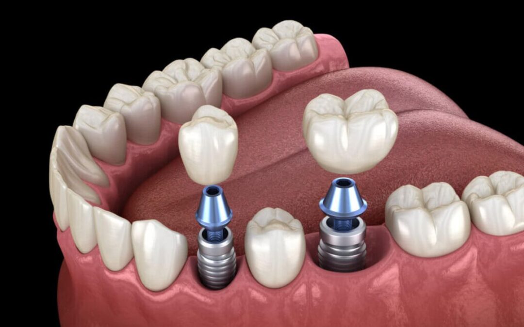 Implantes dentales: ¿son la opción ideal para ti?