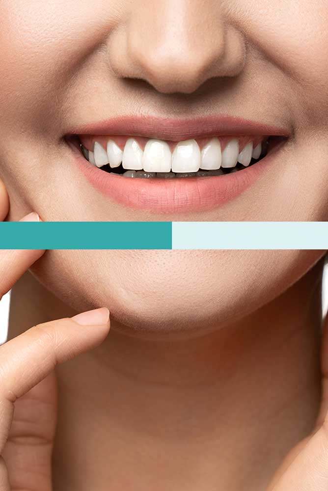 blanqueamiento-dental-combinado-en-jaen